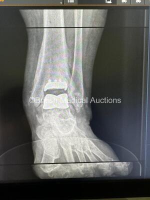 Carestream OnSIght 3D Extremity System Model CBCT-EXTR with PC Unit, Software, Chair, Phantoms and Accessories *S/N2397* **Mfd 12/2016** ***Q1024*** - 45